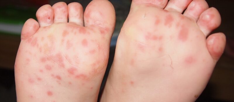 a-contagious-childhood-disease-is-set-to-worsen-with-climate-change